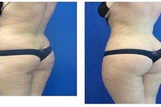 lipoaspiration saint étienne