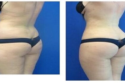 lipoaspiration saint étienne