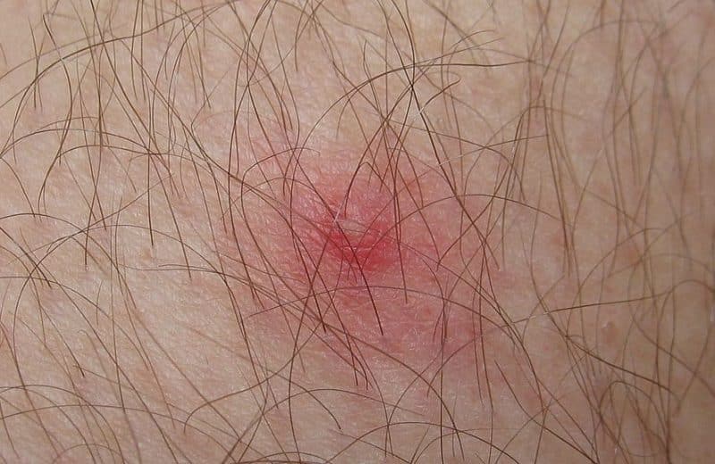 Comment traiter les poils sur le pubis après l’épilation ?